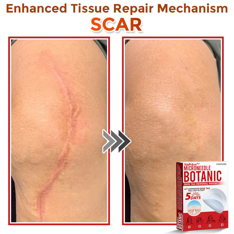 🌈 SkinPrikyn™ MicroNeedle Botanic Skin Tag Removal Patch 🇺🇸 Made in the USA