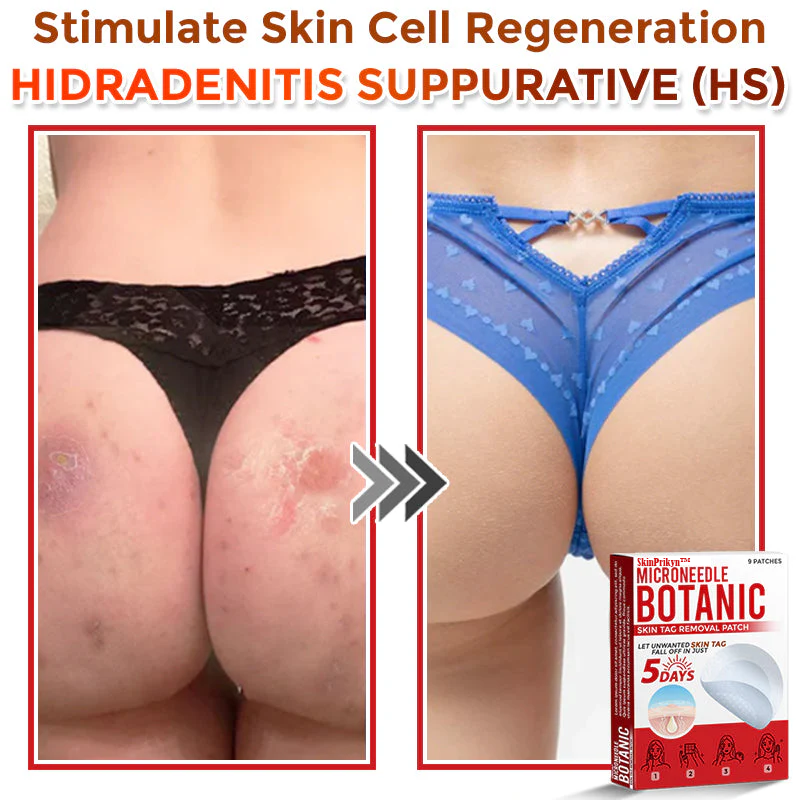 🌈 SkinPrikyn™ MicroNeedle Botanic Skin Tag Removal Patch 🇺🇸 Made in the USA