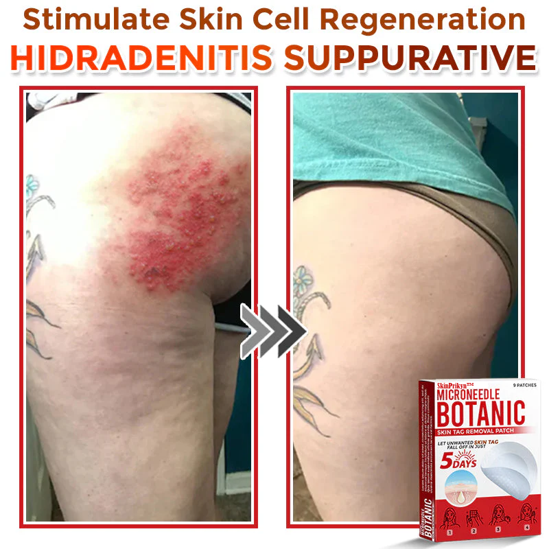 🌈 SkinPrikyn™ MicroNeedle Botanic Skin Tag Removal Patch 🇺🇸 Made in the USA